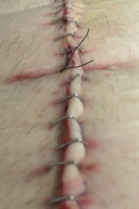Abdominal surgery wound showing staples